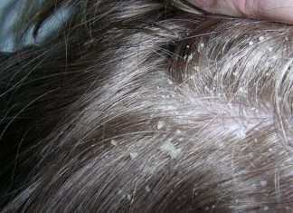 Як позбавитися від лупи в домашніх умовах — найкращі засоби для чоловіків