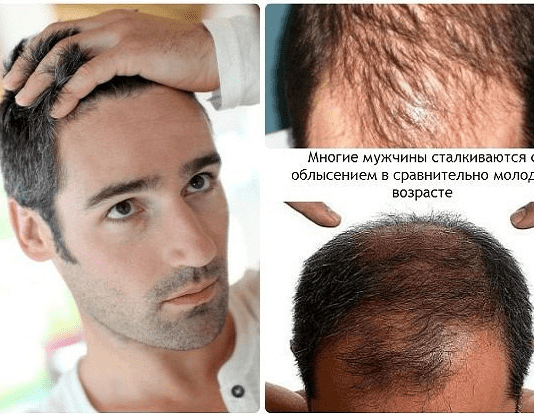 Шампунь від випадіння волосся для чоловіків – основні критерії вибору, рекомендації фахівців